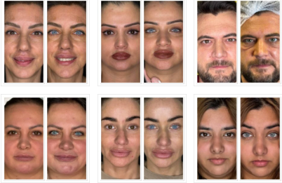 Who Is an Ideal Candidate for Eye Color Change with Keratopigmentation?